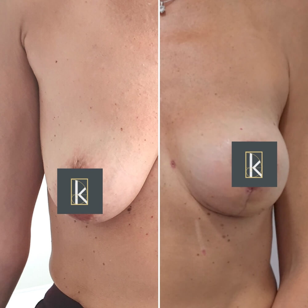Bruststraffung mit Implantaten – Wiederherstellung von Form und Volumen Implantatwechsel & Entfernung
