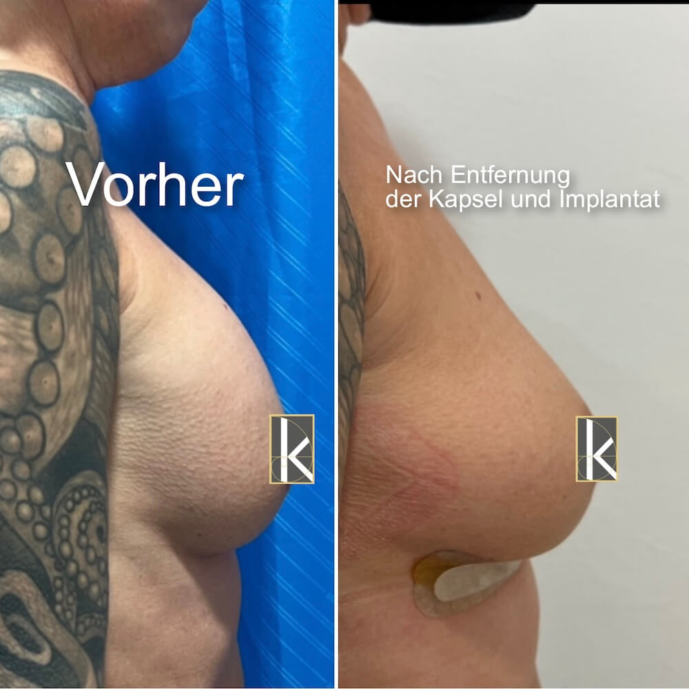 Waterfall-Deformität nach Implantatentfernung Vorher–Nachher