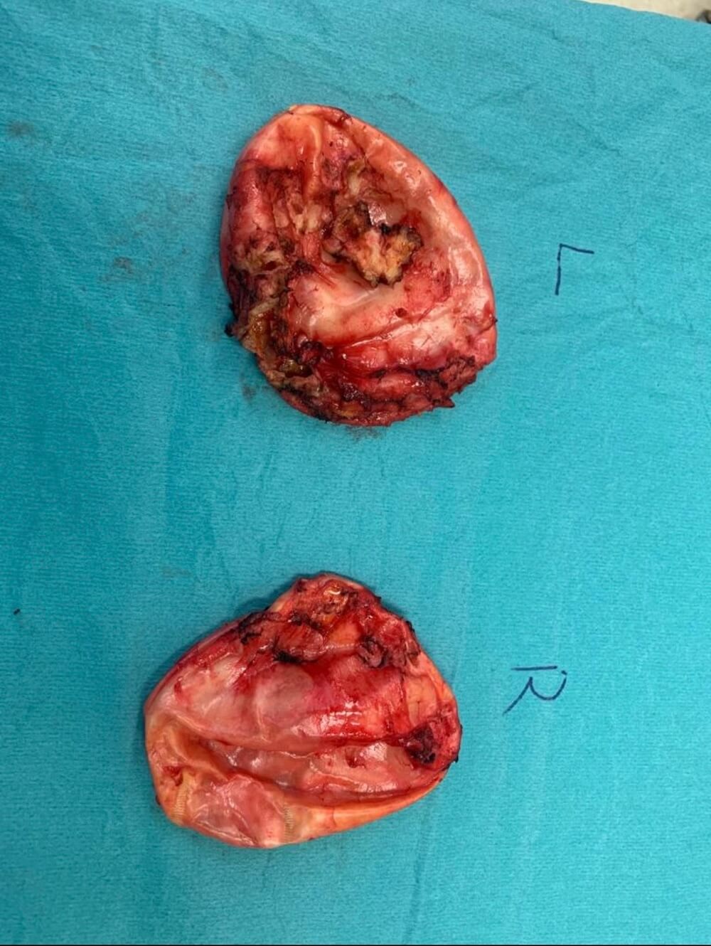 Waterfall Deformitaet nach Implantatentfernung Vorher–Nachher Implantatwechsel & Entfernung